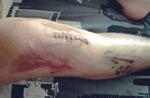 Edward’s leg after his second operation following his motorbike accident